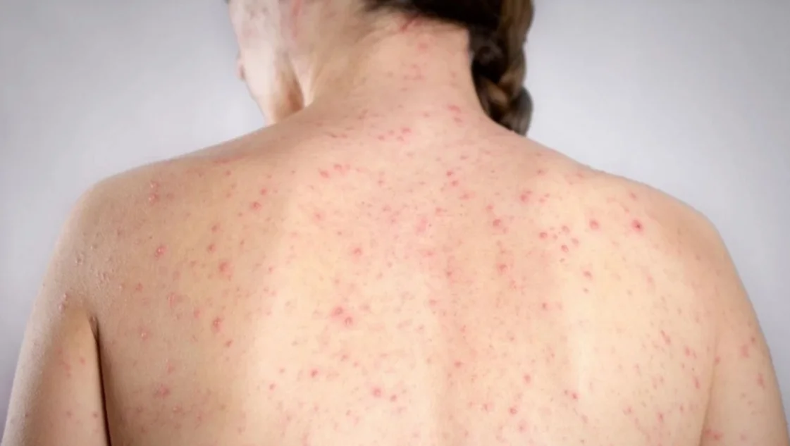 El desesperado ruego del Ministro de Salud por el brote de sarampión