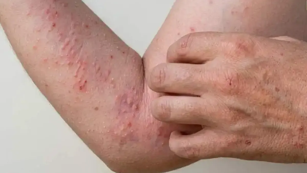 Aumentaron los casos de chikungunya en el país: la mayoría son autóctonos