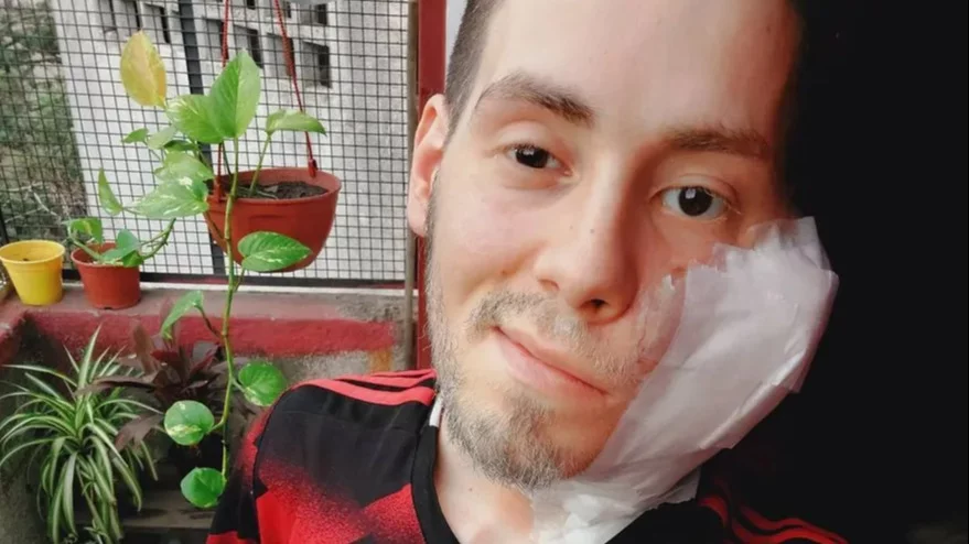 Murió a los 25 años el joven que tenía un tumor en la cara
