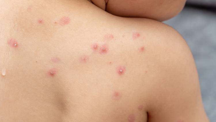 Aprueban una vacuna contra la viruela del mono
