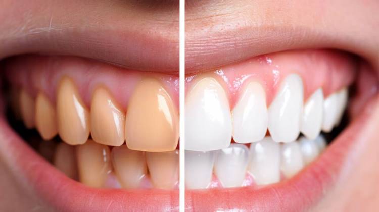 Una infusión ayuda a prevenir y eliminar el sarro en los dientes